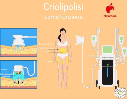 Criolipólisis: qué es, cómo funciona, beneficios y costes