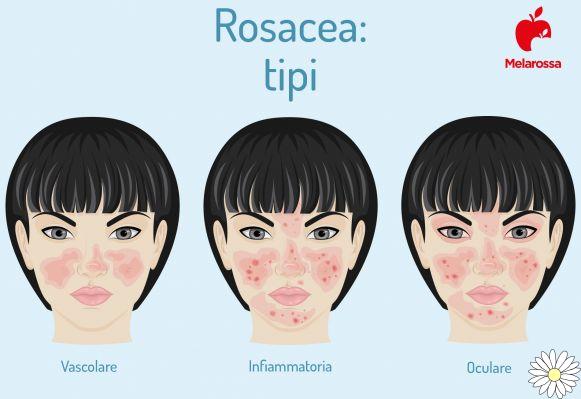 Rosacea: what it is, causes and risk factors, symptoms and treatments