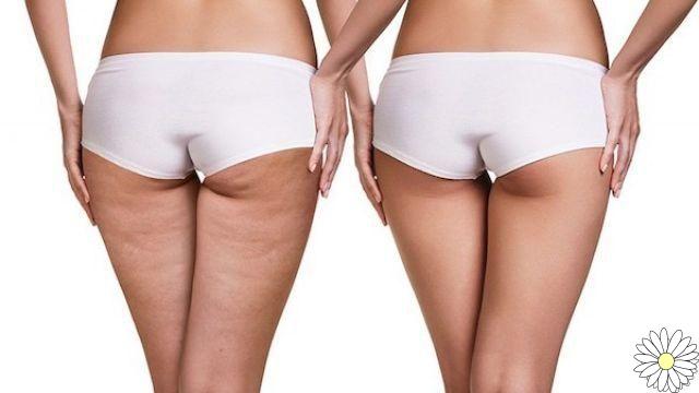 Cellulite: when to resort to treatments?