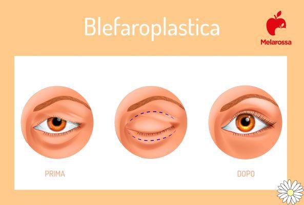 Blepharoplasty: what it is, what it is for, how it is done, how much it costs