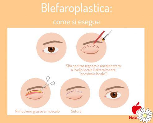 Blefaroplastia: qué es, para qué sirve, cómo se hace, cuánto cuesta